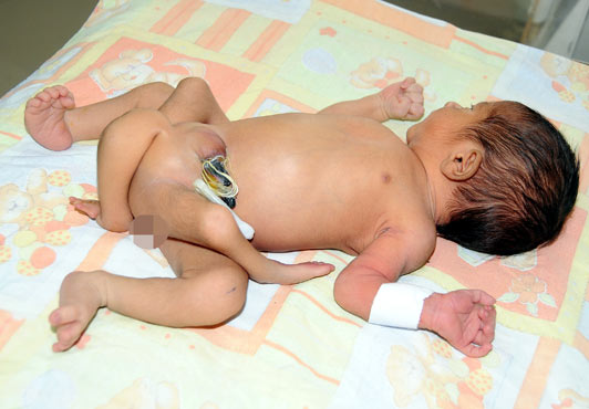 bebe-6-jambes-karachi-pakistan-maladie rare