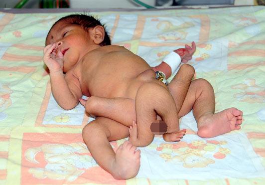 bebe-6-jambes-karachi-pakistan-malforme-rare-maladies-rares-malformation.jpg