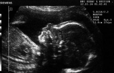 Echographie foetus