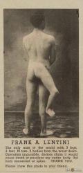 francesco-lentini-malformation-3-jambes.jpg