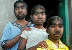 sangli-sisters-werewolf-syndrome-hairy-poil-rare-genetic-mutation-3-soeurs-poilues-du-visage.jpg