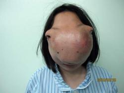wu-xiaoyan-tumeur-visage-insolite-bizare-deformassion-femme-maladie-rare.jpg